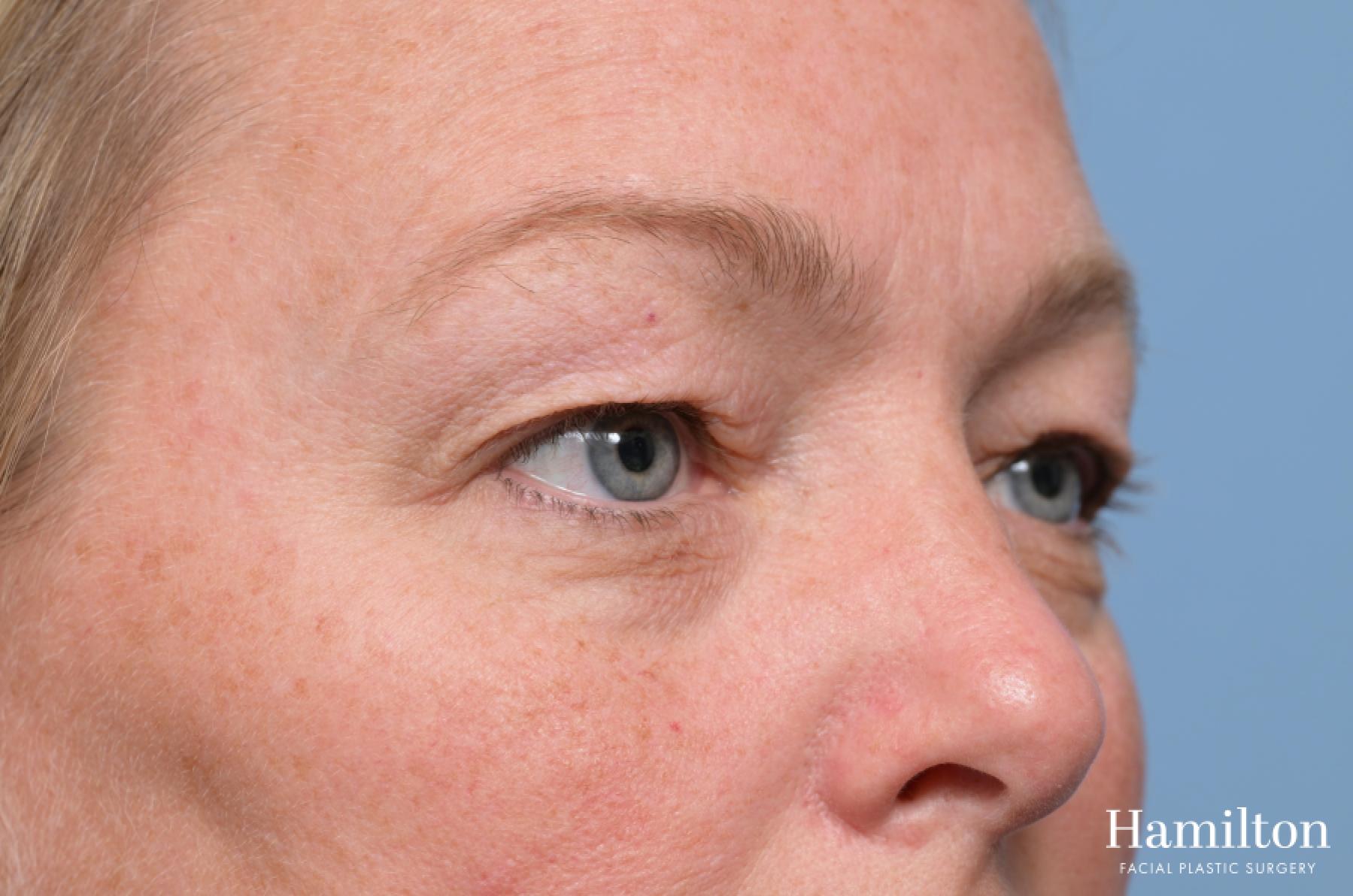 Blepharoplasty: Patient 2 - Before 3