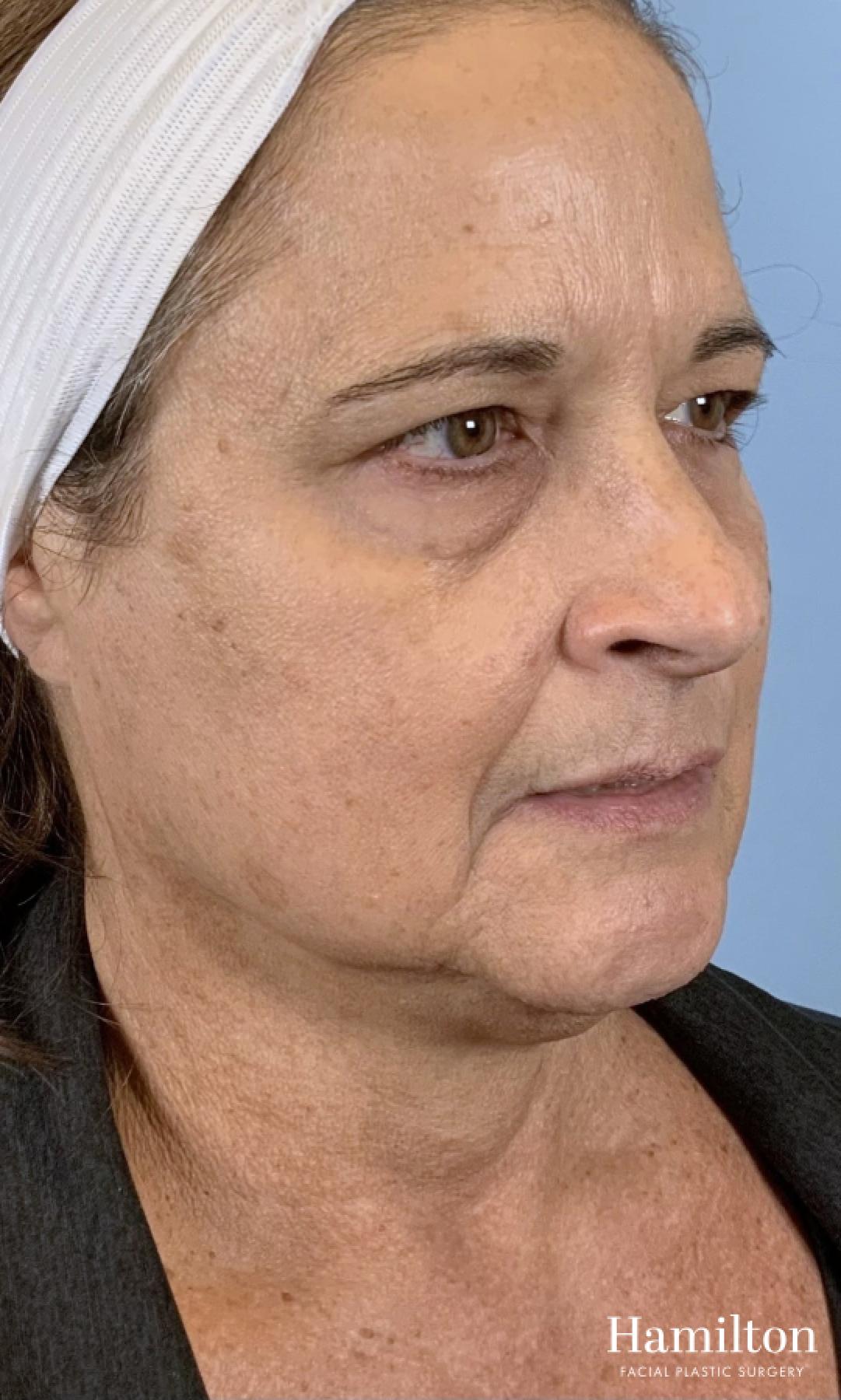 MOXI Laser: Patient 3 - After 2