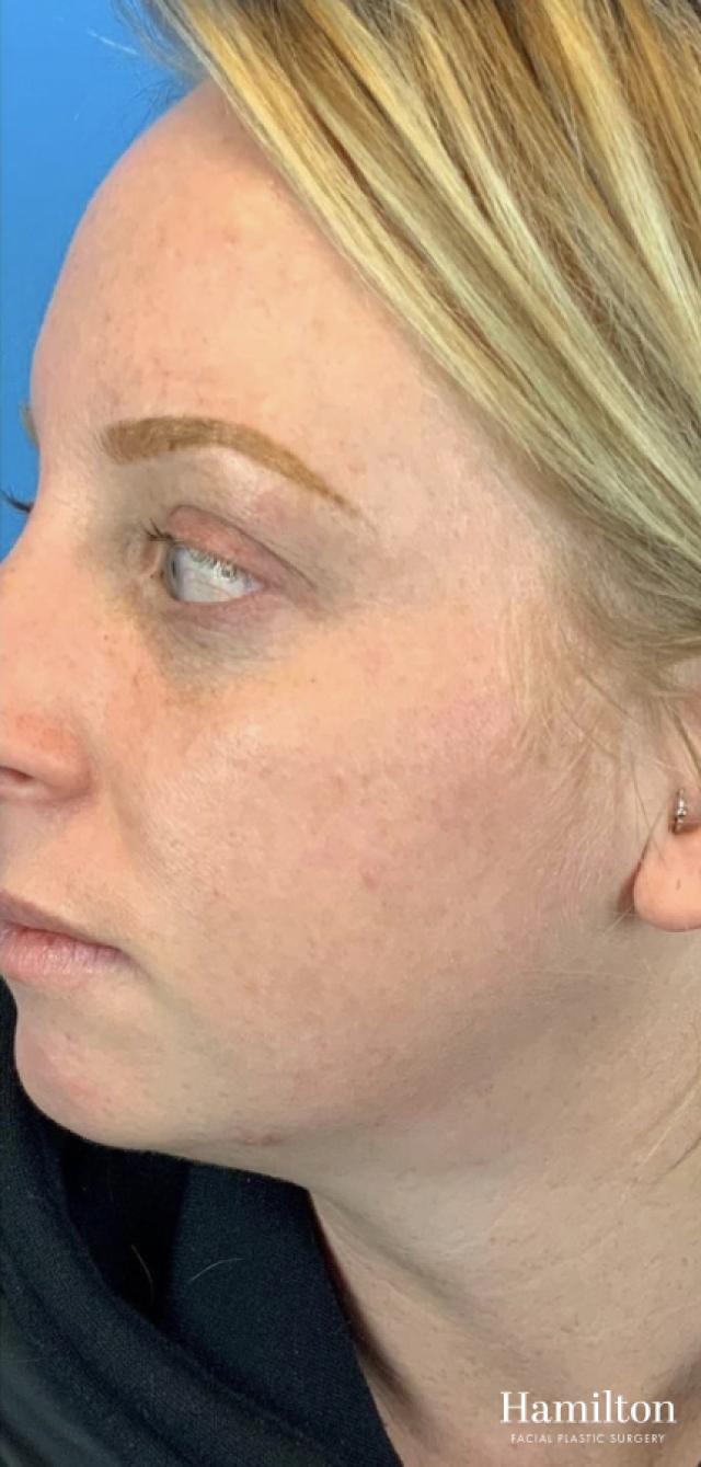 MOXI Laser: Patient 2 - After 3