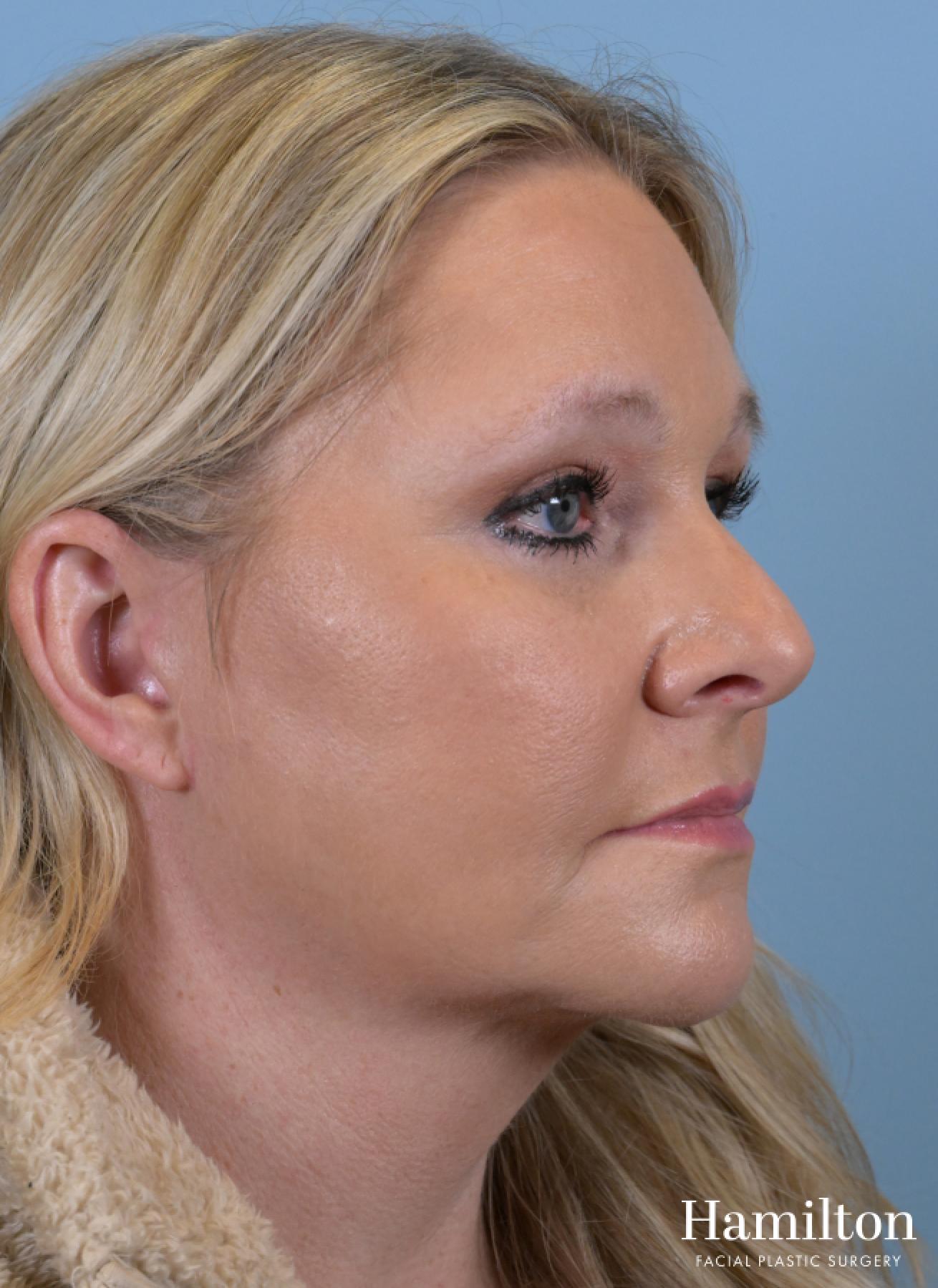 Facelift: Patient 3 - After 5