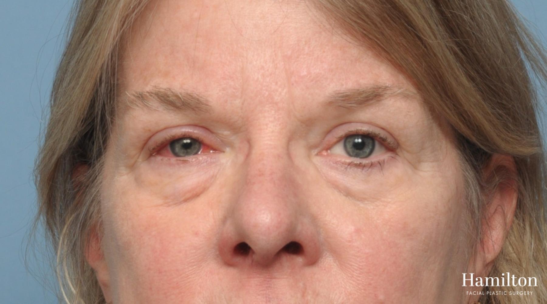 Blepharoplasty: Patient 11 - Before 4
