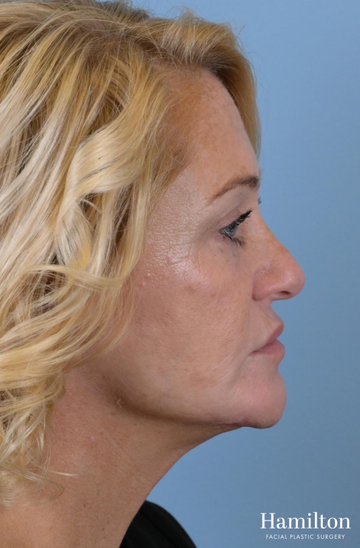 Fillers: Patient 8 - After  