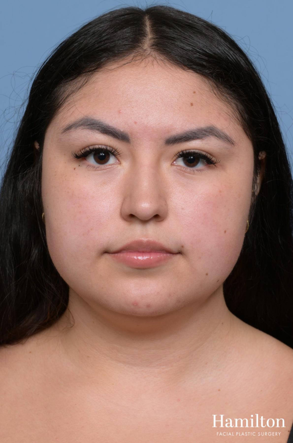 Buccal Fat Removal: Patient 1 - Before 1