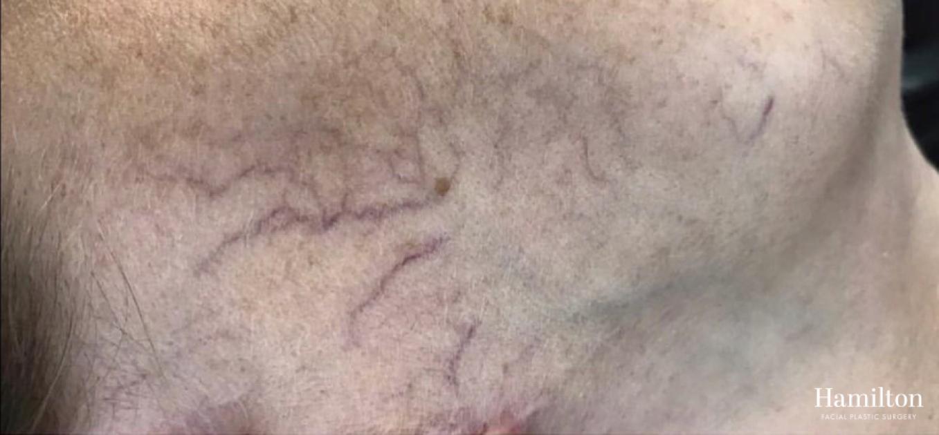 Broad Band Light (BBL): Patient 3 - Before 