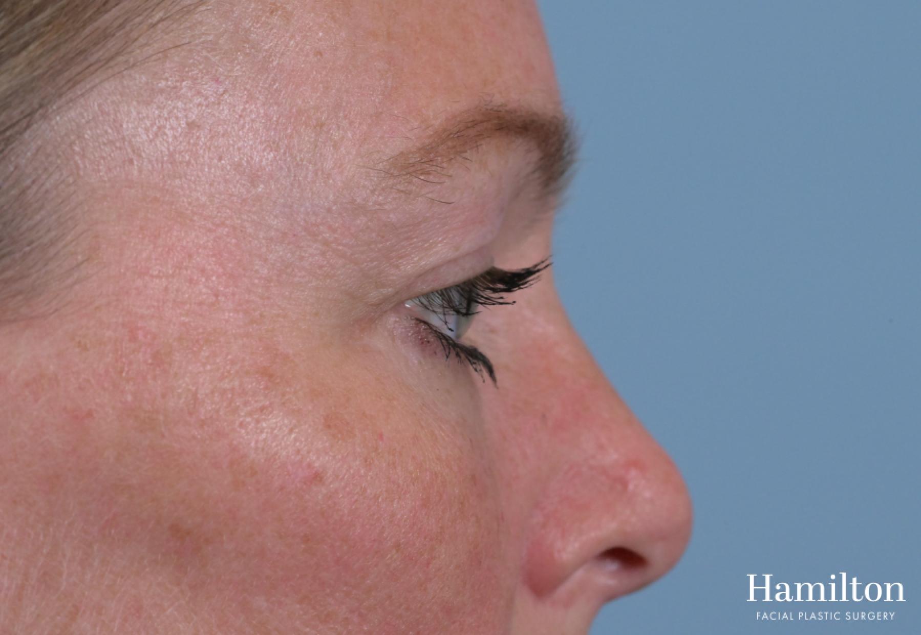 Blepharoplasty: Patient 2 - After 6