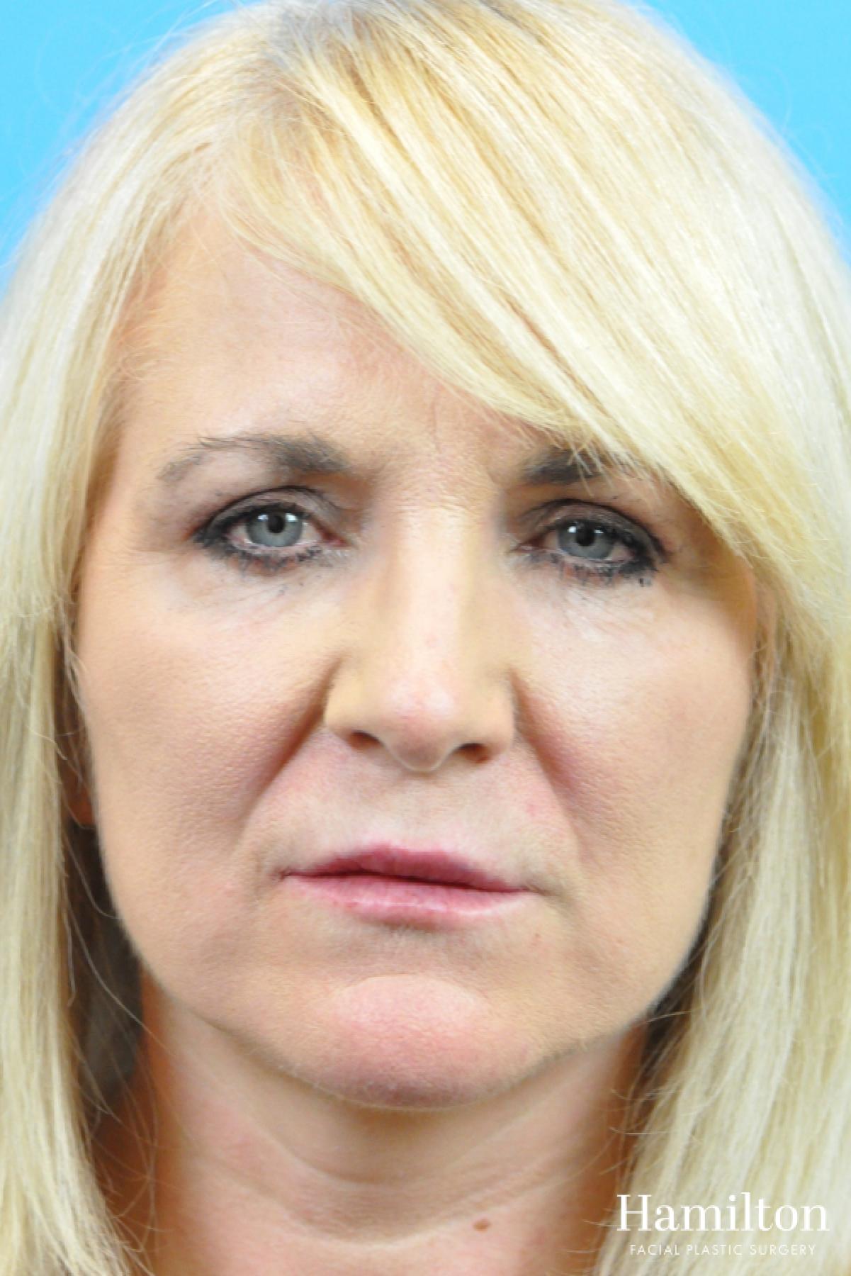 Lip Enhancement: Patient 10 - After  