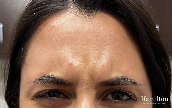 Neurotoxins/Botox: Patient 9 - Before 1