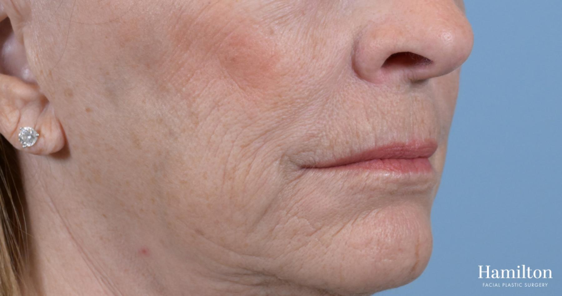 Sciton Laser: Patient 2 - Before 3