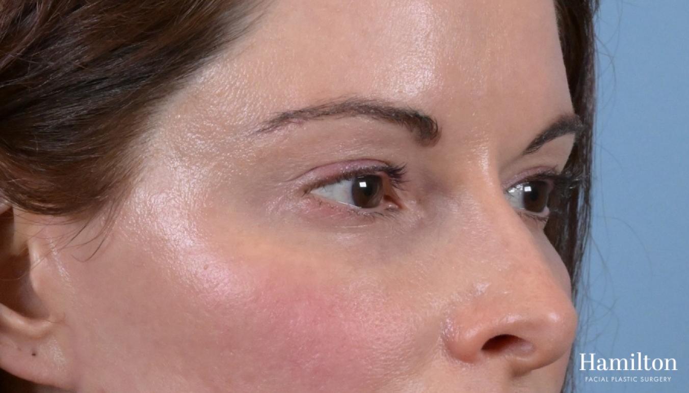 Blepharoplasty: Patient 6 - After 2