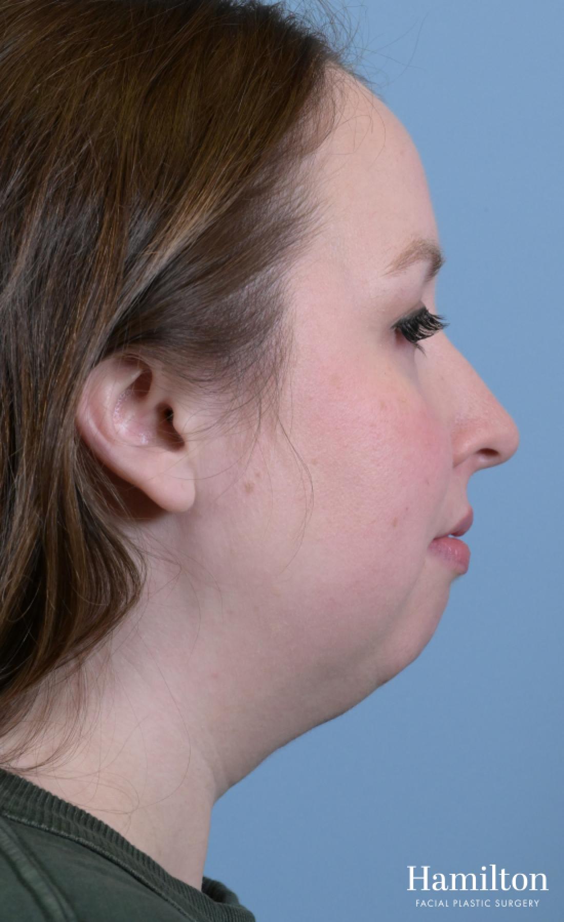 Submentoplasty/Deep Neck Lift: Patient 1 - Before 2