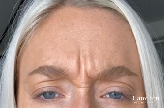 Neurotoxins/Botox: Patient 2 - Before 