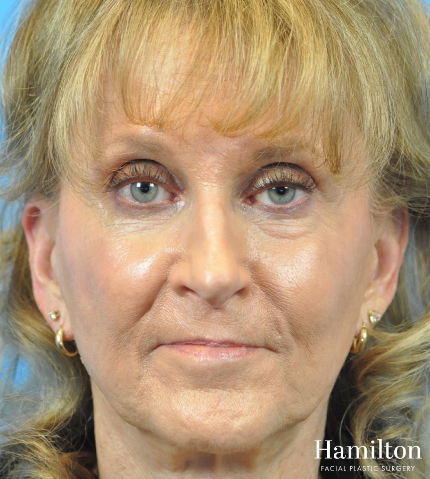 Fillers: Patient 13 - After 3