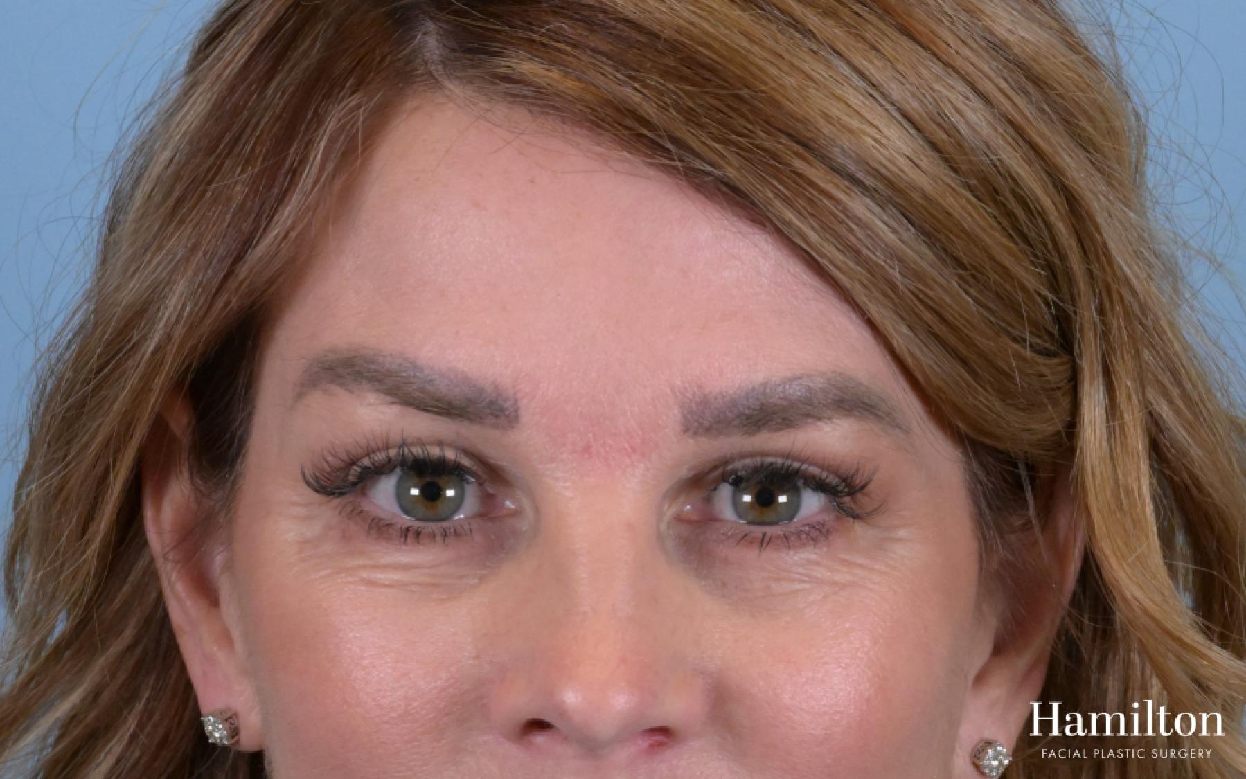 Blepharoplasty: Patient 8 - After  