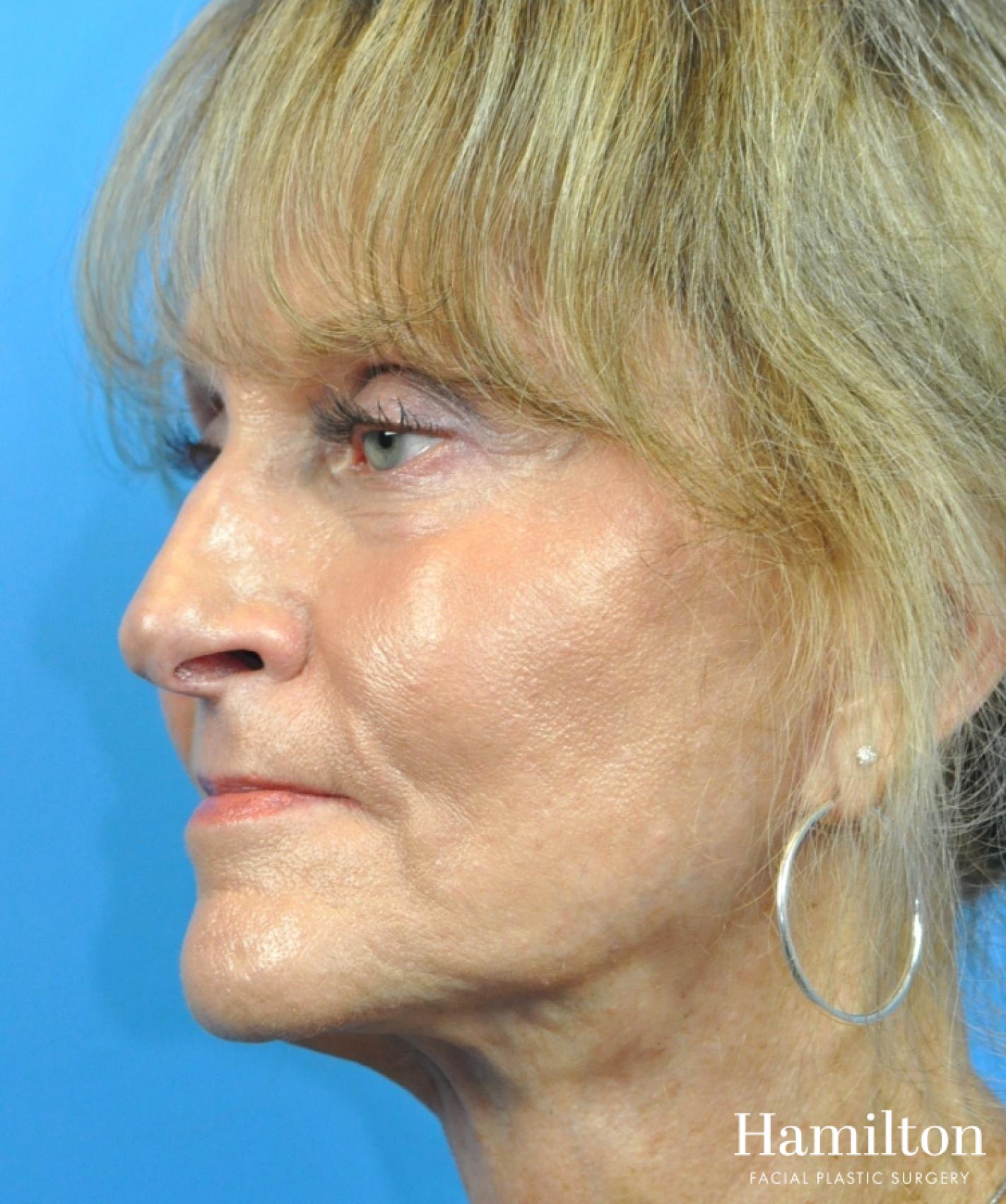 Fillers: Patient 13 - Before 2
