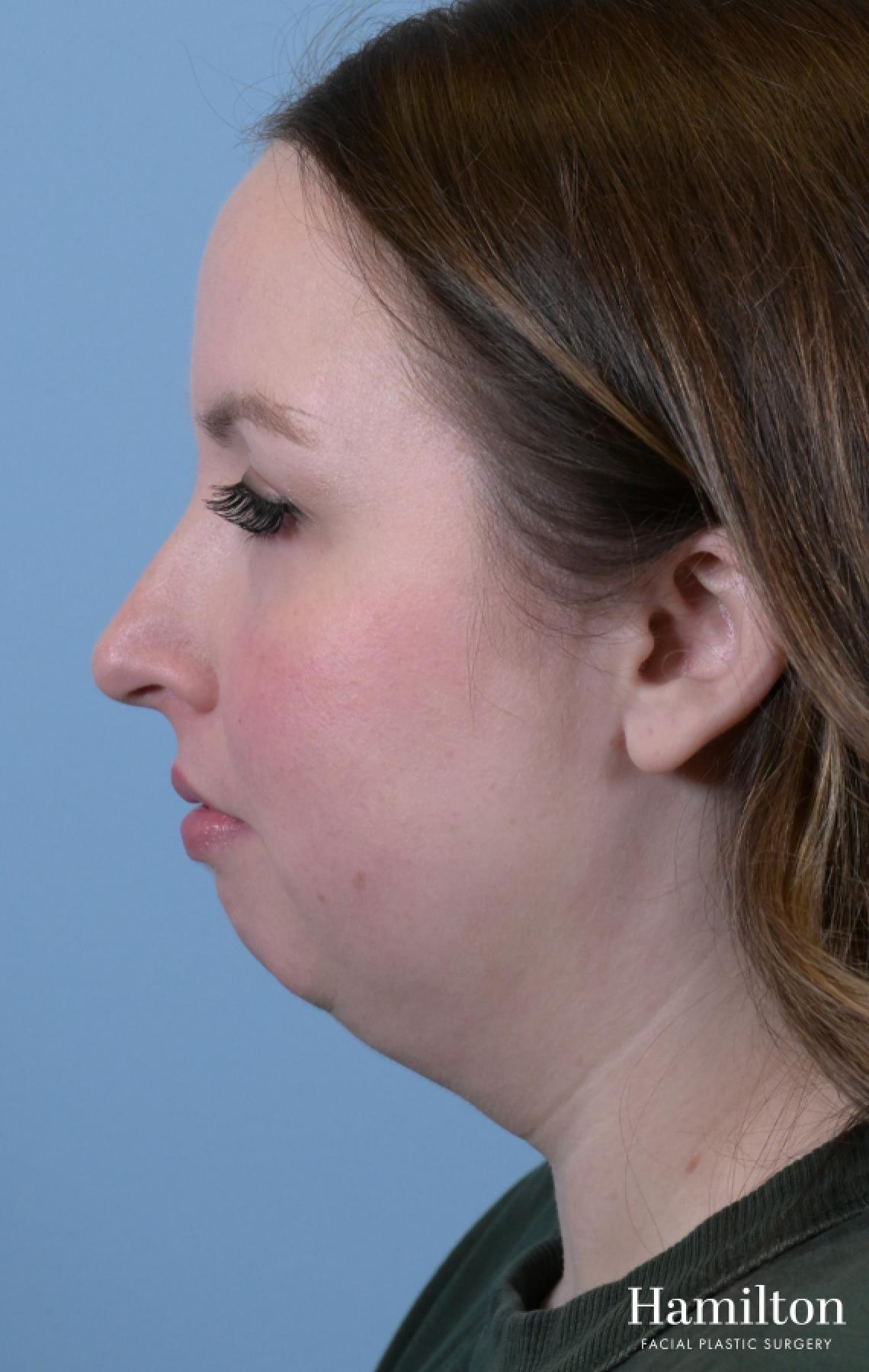Submentoplasty/Deep Neck Lift: Patient 1 - Before