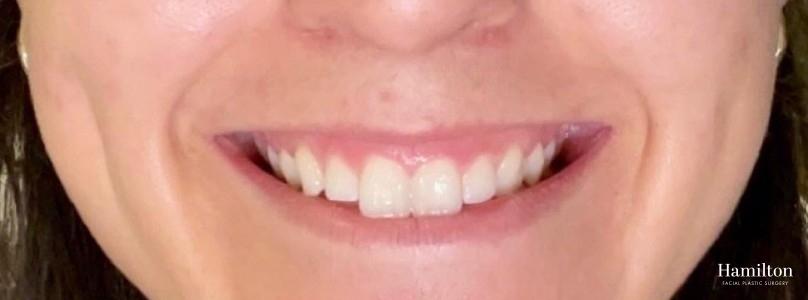 Neurotoxins/Botox: Patient 6 - Before 