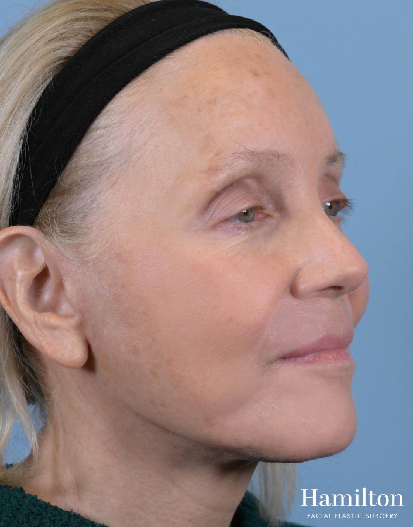 Facelift: Patient 3 - After 2