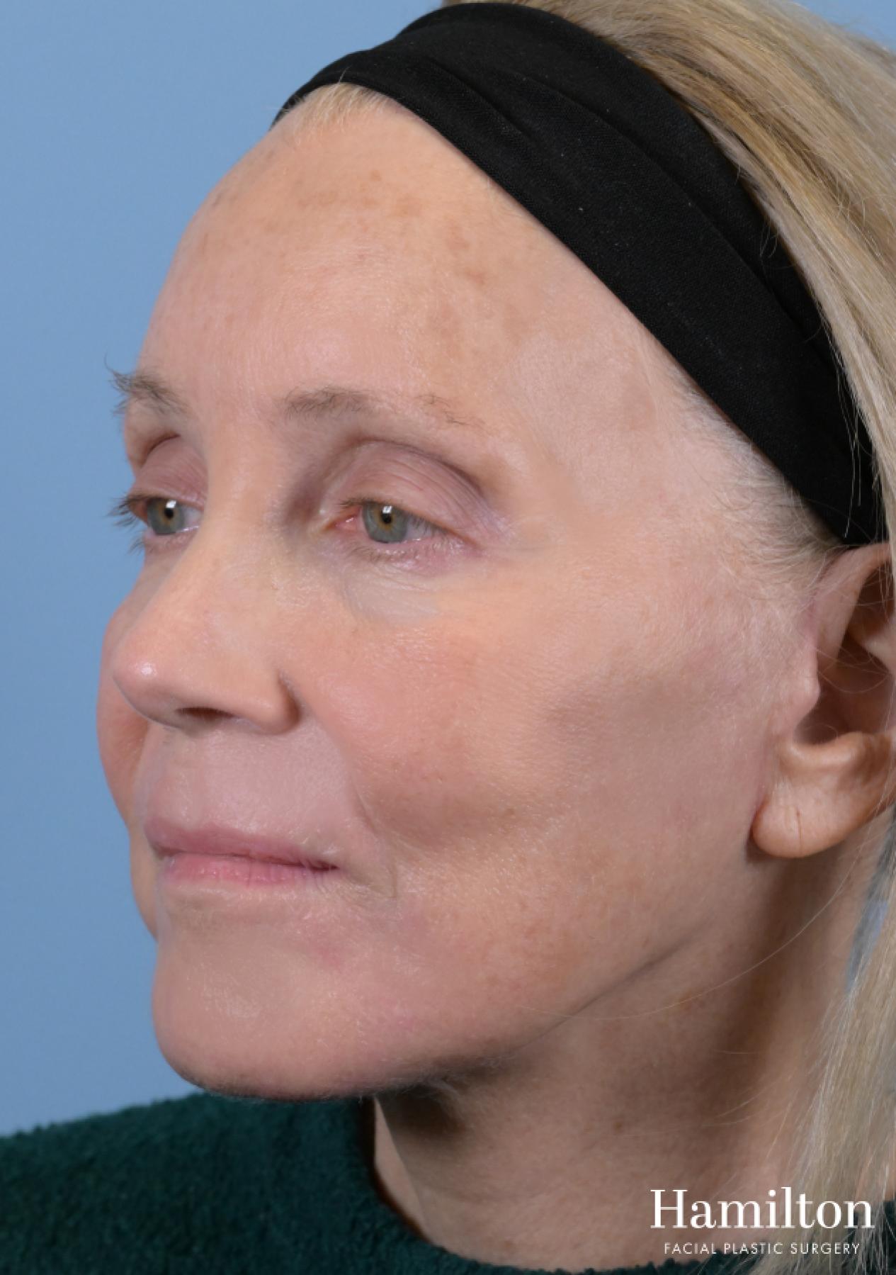 Facelift: Patient 3 - After 4