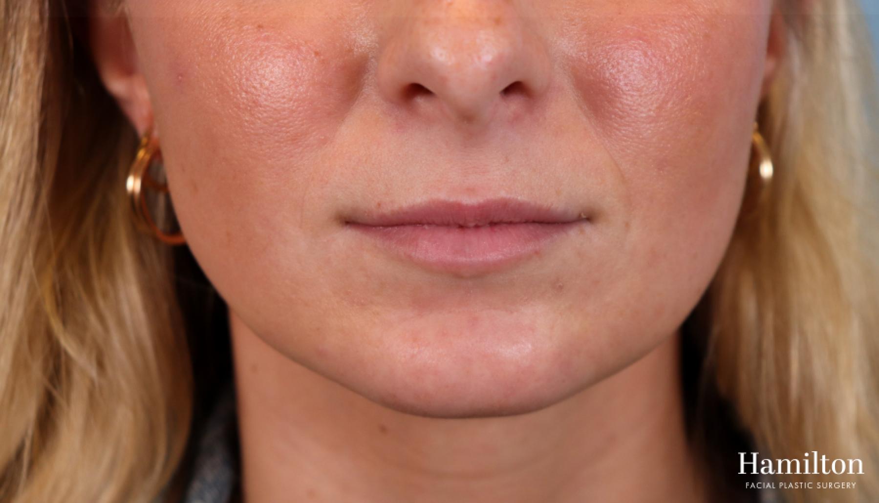 Lip Enhancement: Patient 7 - Before 3