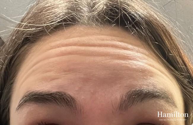 Neurotoxins/Botox: Patient 8 - Before 