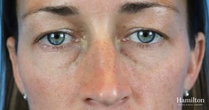 Fillers: Patient 5 - After 1