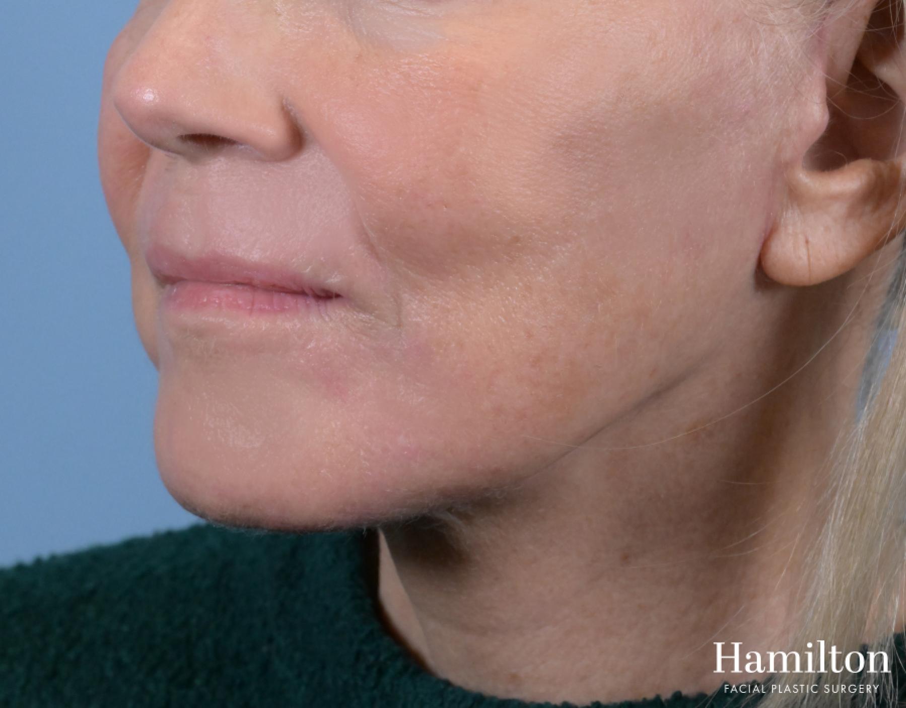 Sciton Laser: Patient 1 - After 2