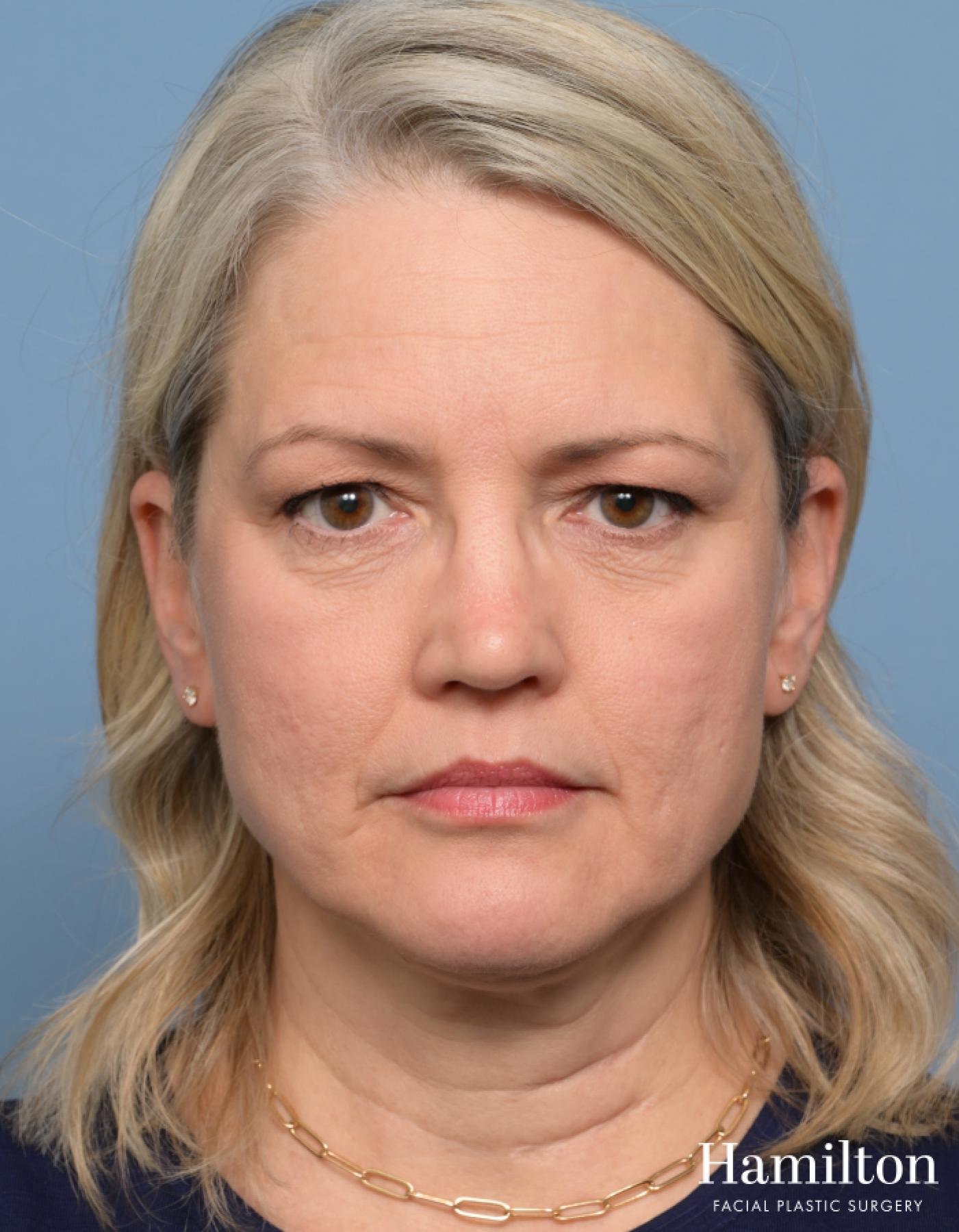 Brow Lift: Patient 3 - Before 