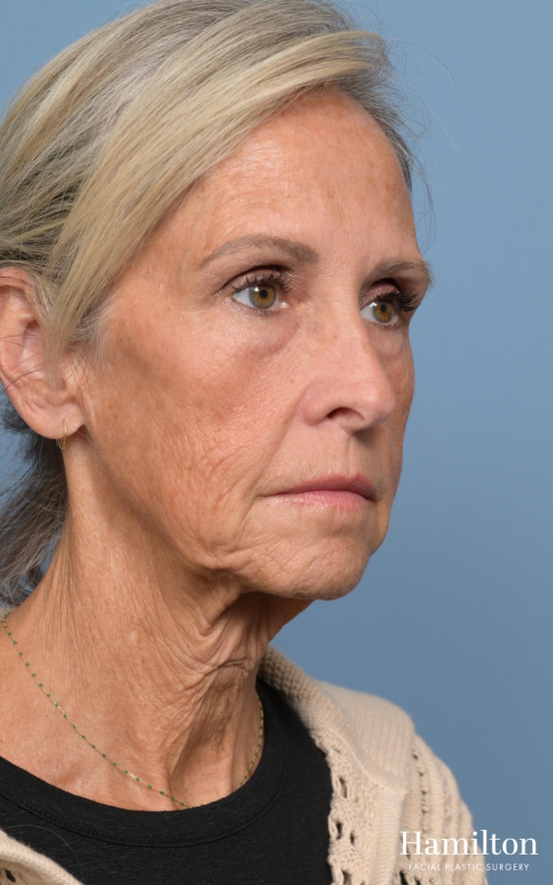 Fat Grafting: Patient 1 - Before 2