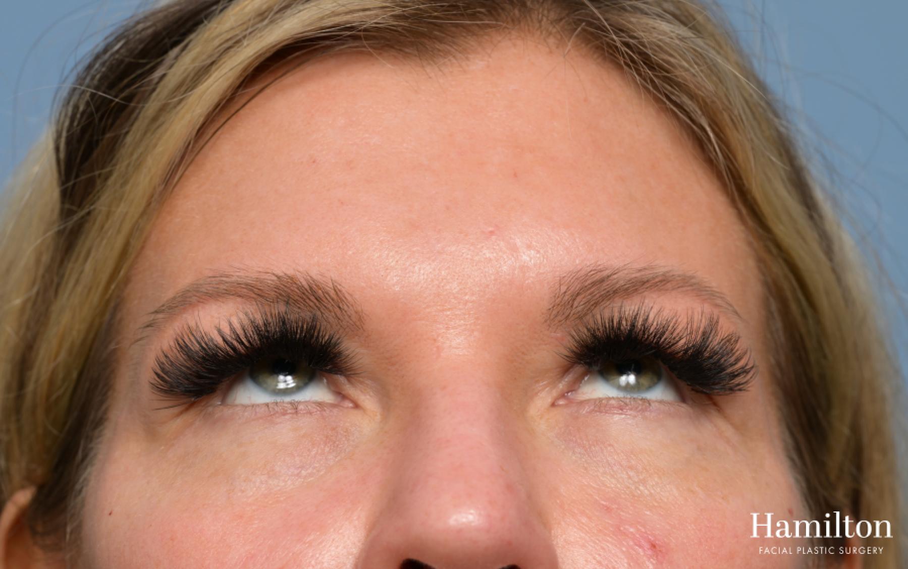 Blepharoplasty: Patient 4 - Before and After 4