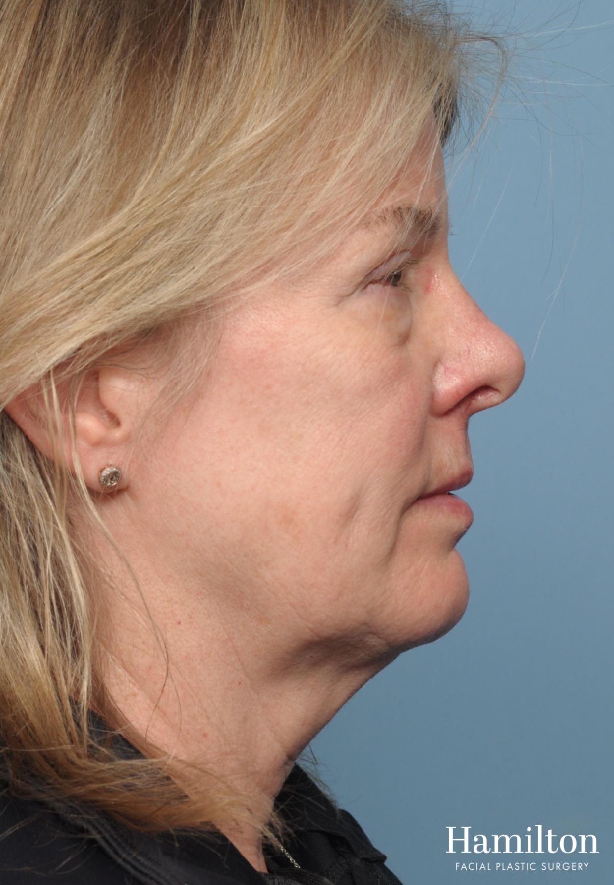 Facelift: Patient 43 - Before 2