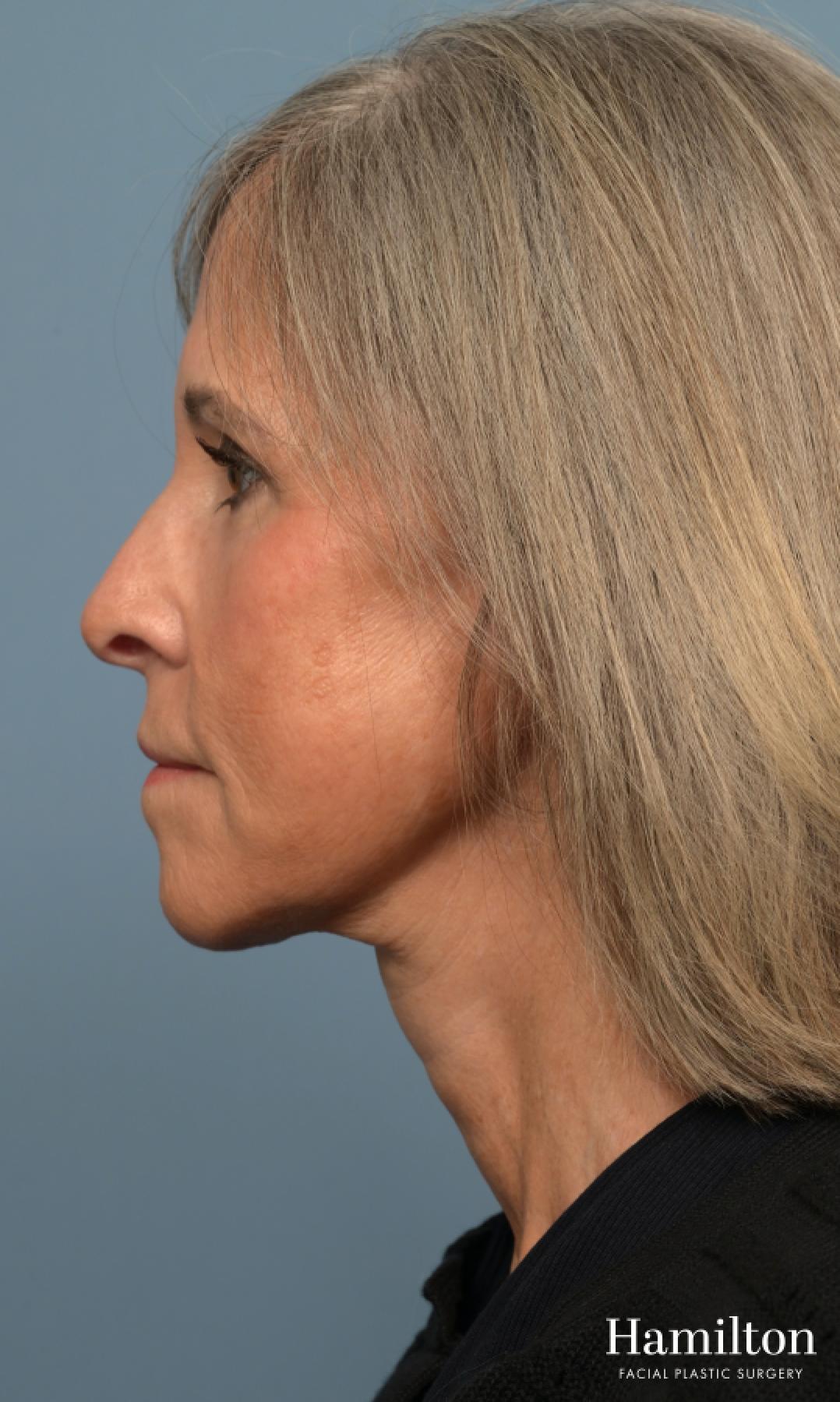 Fat Grafting: Patient 1 - After 5_2