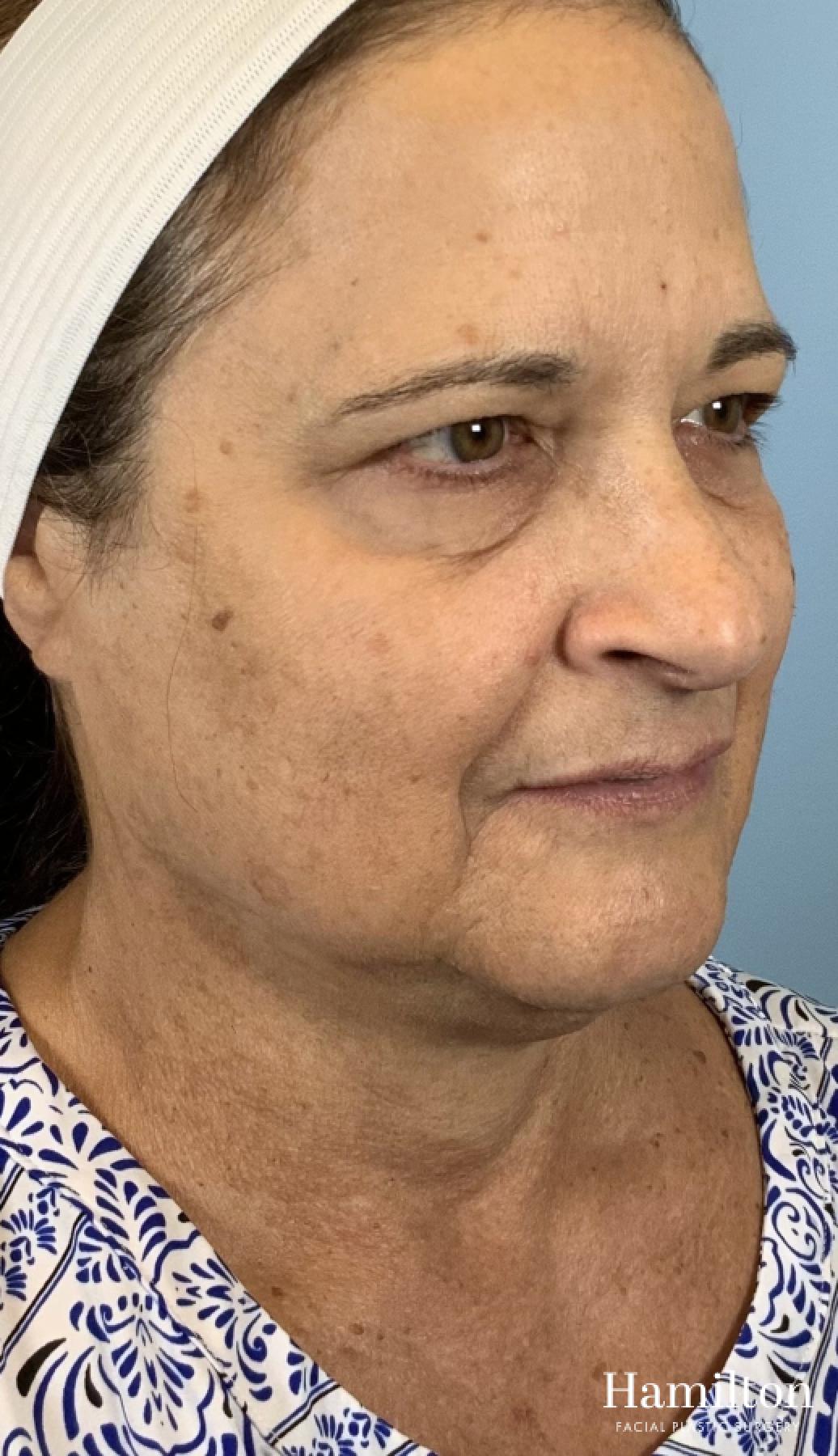 MOXI Laser: Patient 3 - Before 2