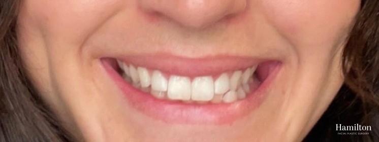 BOTOX® Cosmetic: Patient 6 - After 1