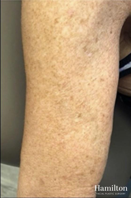 Broad Band Light (BBL): Patient 7 - Before 