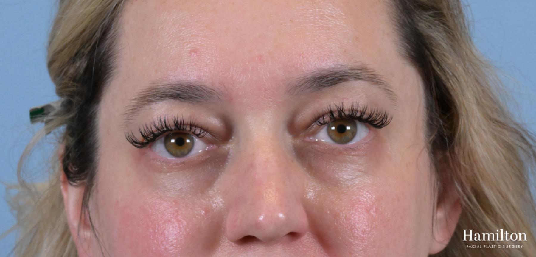 Blepharoplasty: Patient 4 - Before