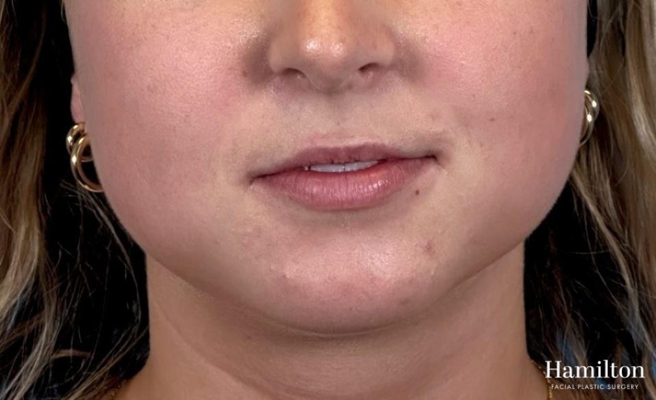 Fillers: Patient 2 - Before 