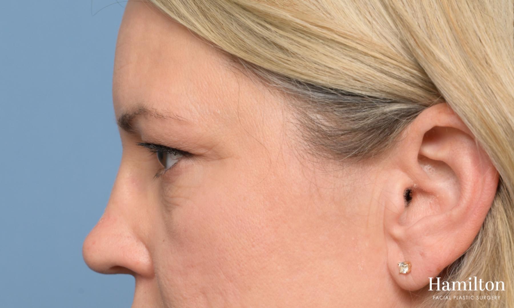 Blepharoplasty: Patient 5 - Before 2