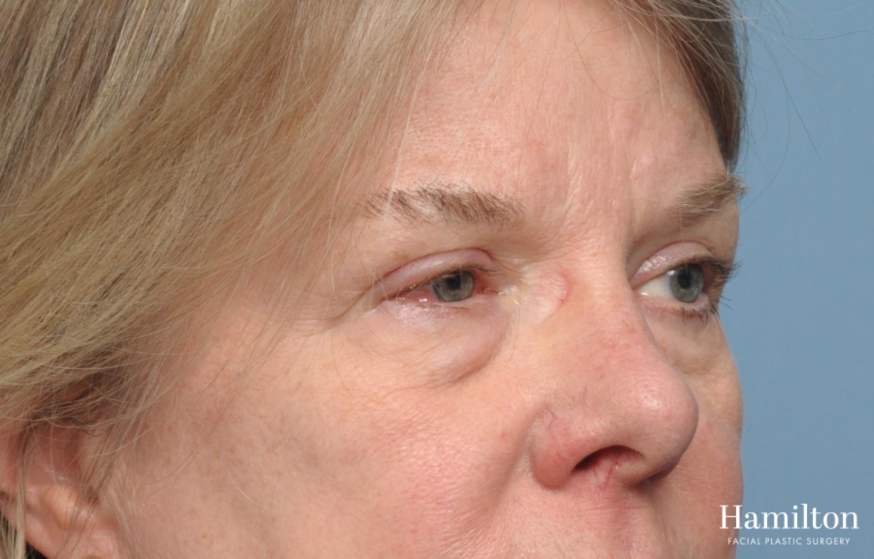 Blepharoplasty: Patient 11 - Before 1