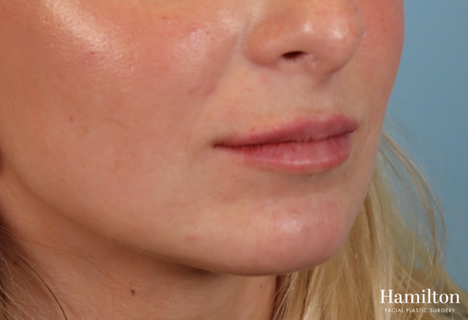 Fillers: Patient 9 - After  