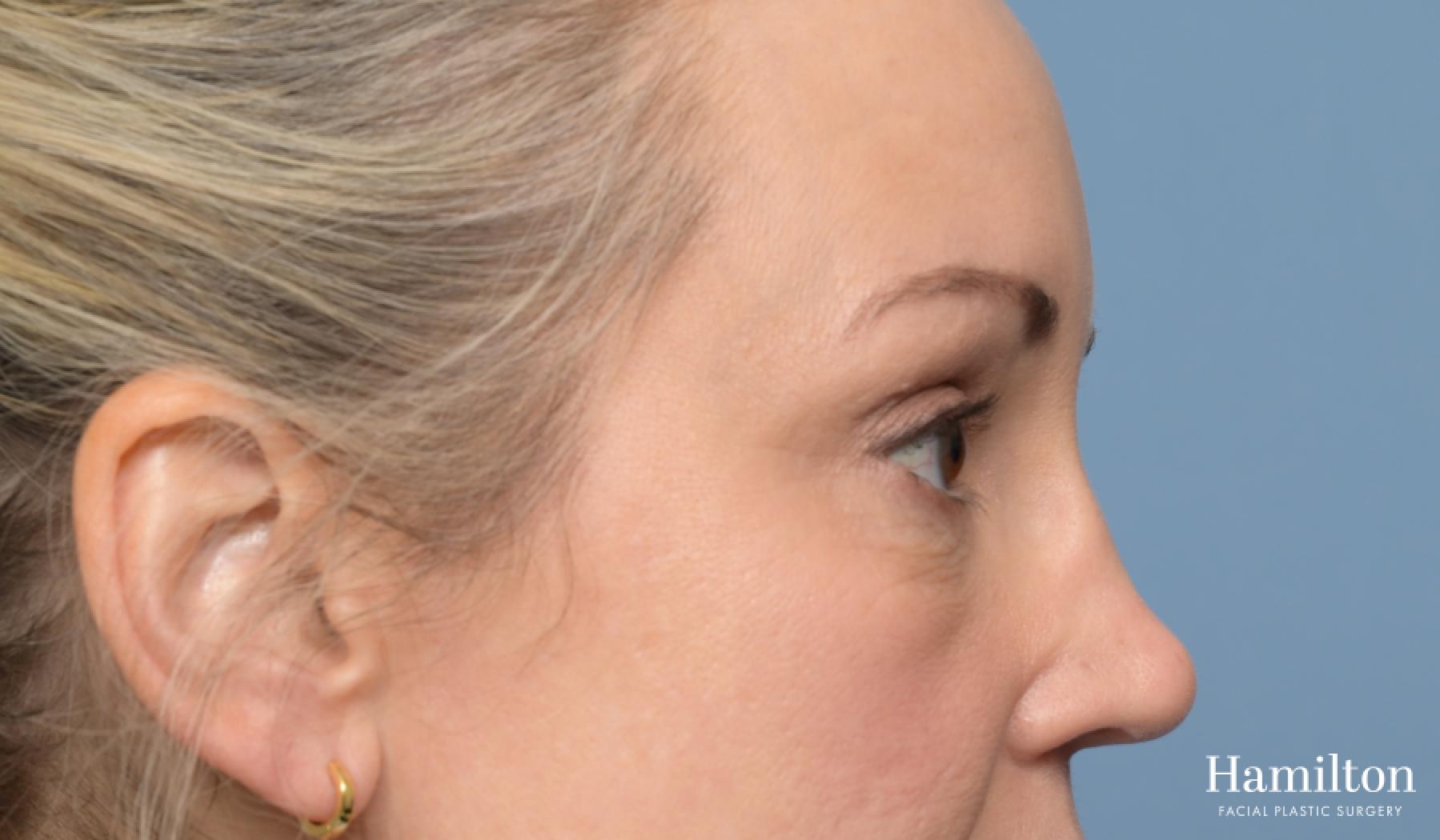 Blepharoplasty: Patient 5 - After 3