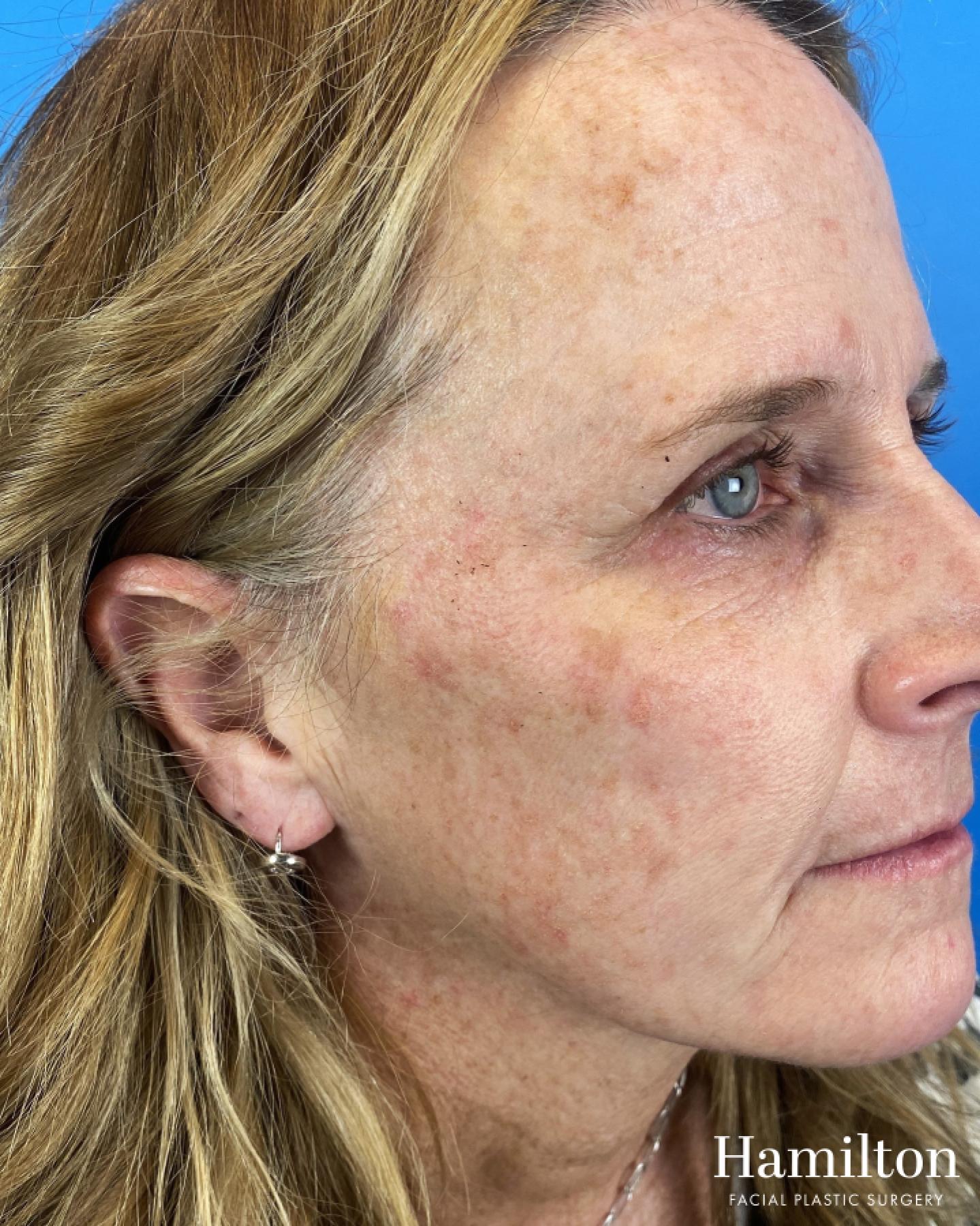 HALO Laser: Patient 3 - Before 
