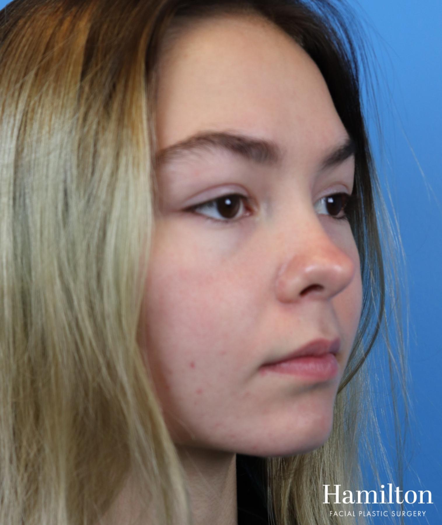 Fillers: Patient 1 - Before and After 4