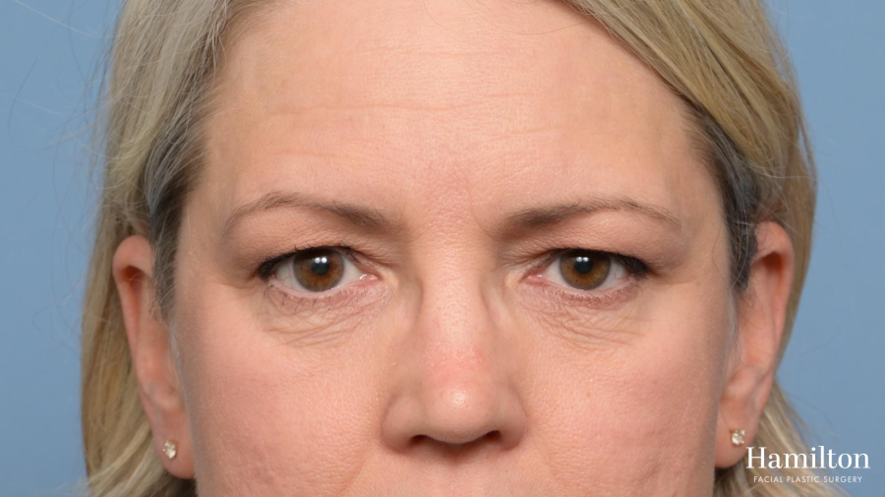 Blepharoplasty: Patient 5 - Before 4