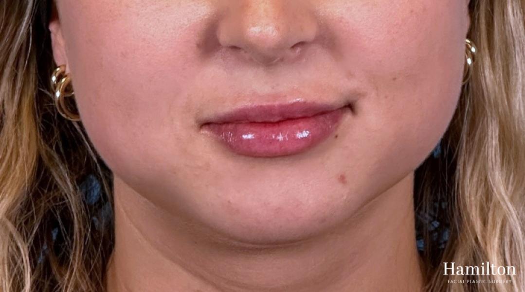 Fillers: Patient 2 - After  