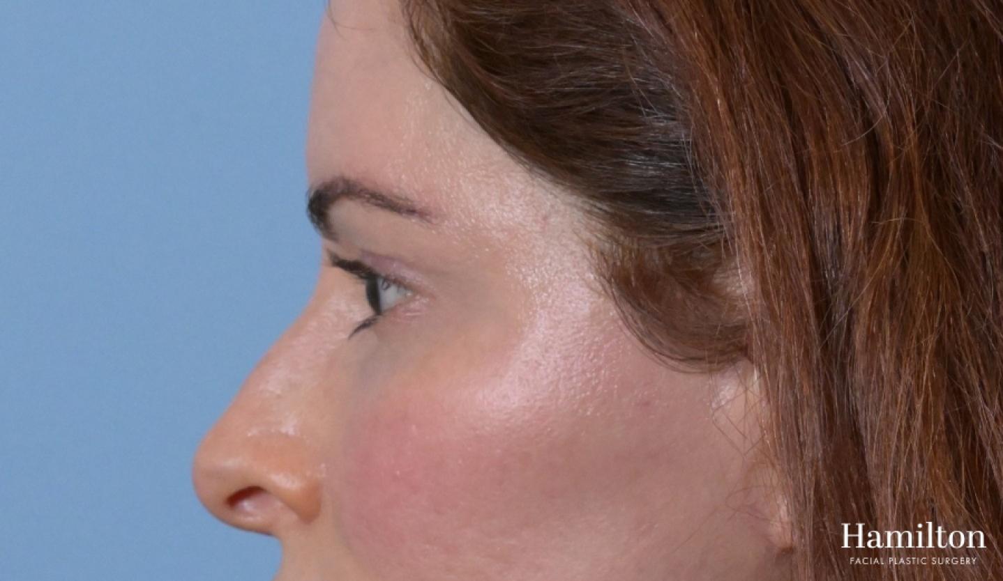 Blepharoplasty: Patient 6 - After 3