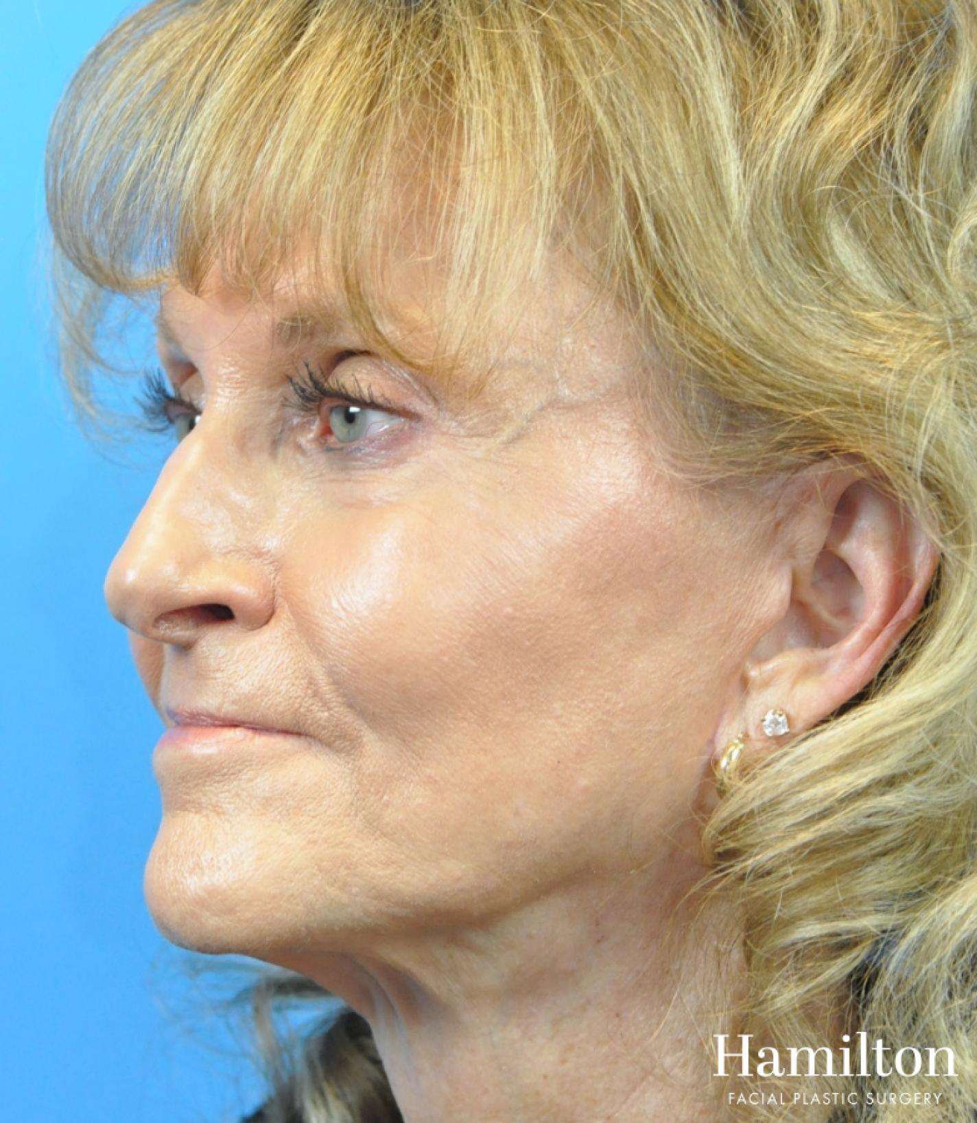 Fillers: Patient 13 - After 2