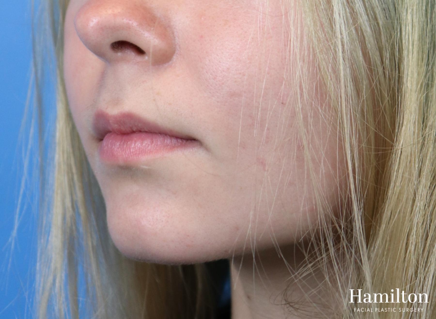 Fillers: Patient 1 - Before 3
