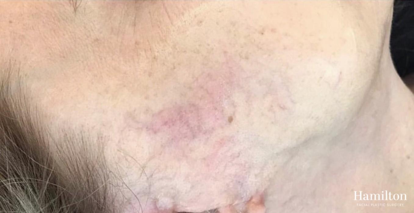 Broad Band Light (BBL): Patient 3 - After  