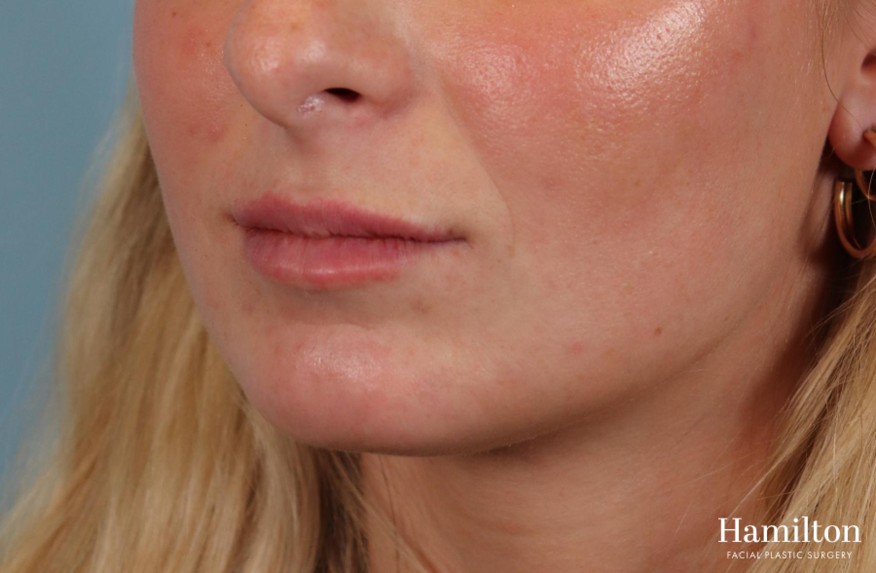 Lip Enhancement: Patient 7 - After 3