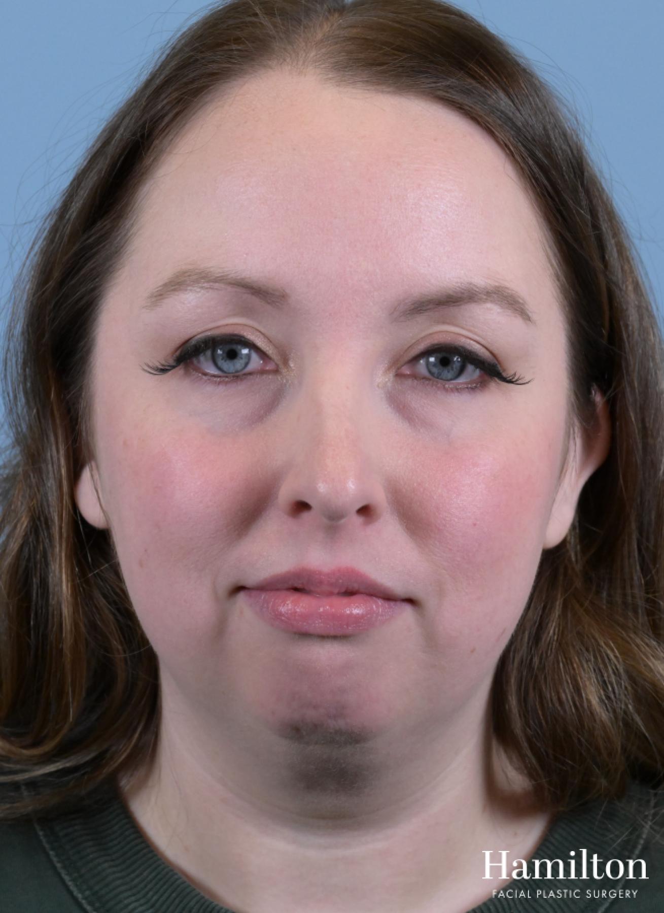 Submentoplasty/Deep Neck Lift: Patient 1 - Before 3